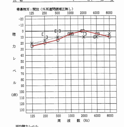 突発性難聴完治例３で使用するオージオグラム写真