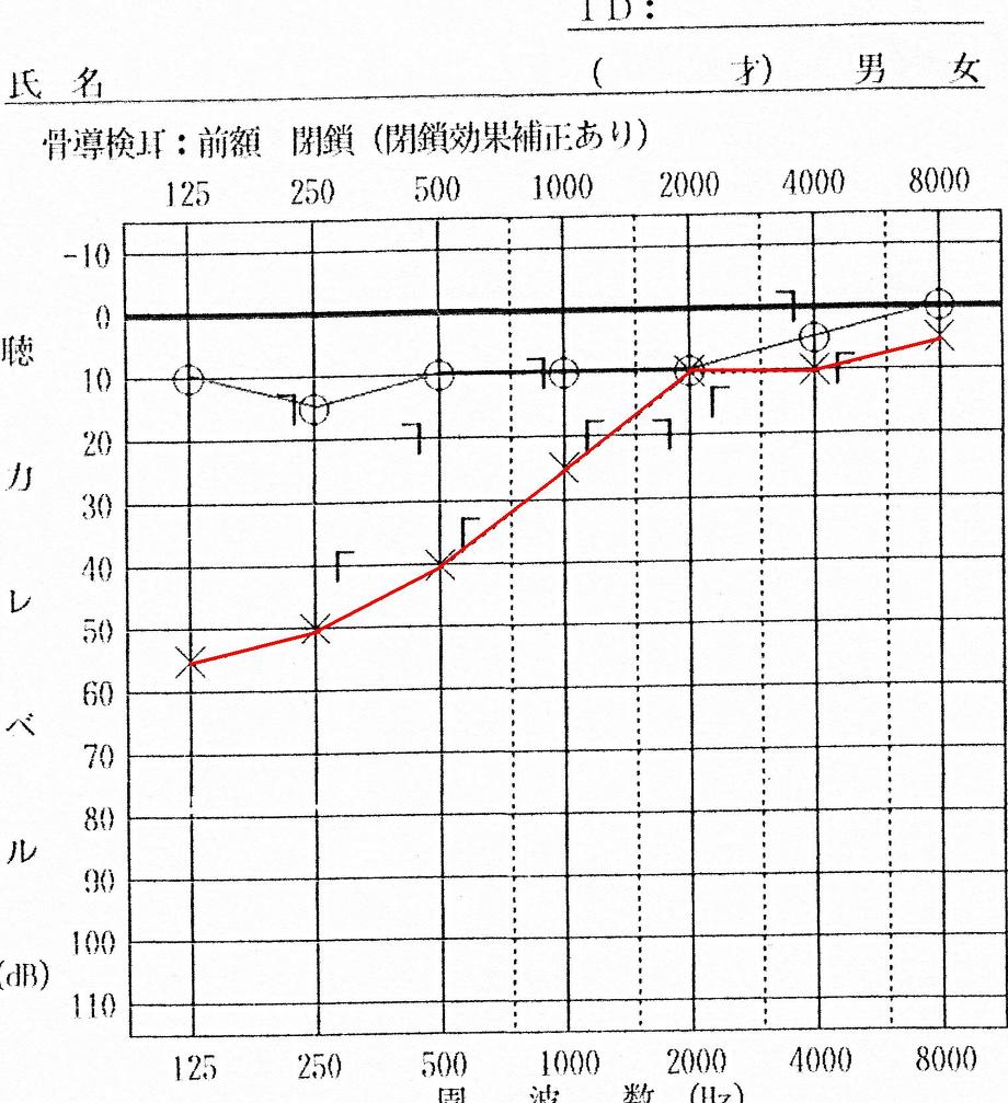 低音障害型感音難聴の治療を行う前のオージオグラムです。